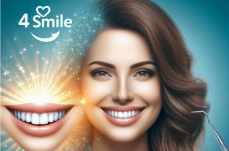 Dental Veneers